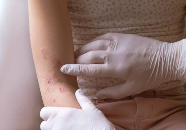 Managing allergies in children